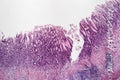 Chronic atrophic gastritis, light micrograph