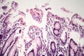 Chronic atrophic gastritis, light micrograph