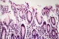 Chronic atrophic gastritis, light micrograph Royalty Free Stock Photo