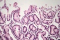 Chronic atrophic gastritis, light micrograph