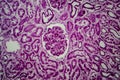 Diffuse sclerosing glomerulonephritis Royalty Free Stock Photo
