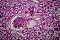 Diffuse sclerosing glomerulonephritis Royalty Free Stock Photo