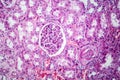 Histopathology of hypertensive renal disease, light micrograph Royalty Free Stock Photo