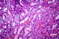 Histopathology of hypertensive renal disease, light micrograph