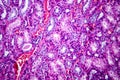 Histopathology of hypertensive renal disease, light micrograph Royalty Free Stock Photo