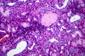 Histopathology of hypertensive renal disease, light micrograph