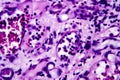 Histopathology of interstitial nephritis Royalty Free Stock Photo
