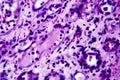 Histopathology of interstitial nephritis Royalty Free Stock Photo