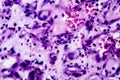 Histopathology of interstitial nephritis Royalty Free Stock Photo