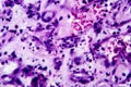 Histopathology of interstitial nephritis