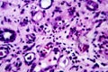 Histopathology of interstitial nephritis Royalty Free Stock Photo