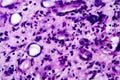 Histopathology of interstitial nephritis Royalty Free Stock Photo