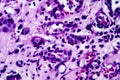 Histopathology of interstitial nephritis Royalty Free Stock Photo