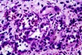Histopathology of interstitial nephritis Royalty Free Stock Photo