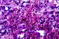 Histopathology of interstitial nephritis Royalty Free Stock Photo