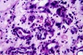 Histopathology of interstitial nephritis Royalty Free Stock Photo