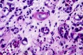 Histopathology of interstitial nephritis Royalty Free Stock Photo