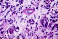 Histopathology of interstitial nephritis