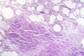 Histopathology of interstitial pneumonia Royalty Free Stock Photo