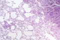 Histopathology of interstitial pneumonia Royalty Free Stock Photo
