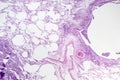 Histopathology of interstitial pneumonia Royalty Free Stock Photo