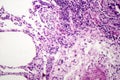 Histopathology of interstitial pneumonia Royalty Free Stock Photo