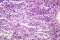 Histopathology of interstitial pneumonia Royalty Free Stock Photo