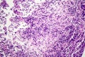 Histopathology of interstitial pneumonia Royalty Free Stock Photo