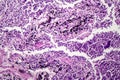 Histopathology of interstitial pneumonia Royalty Free Stock Photo