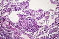 Histopathology of interstitial pneumonia Royalty Free Stock Photo