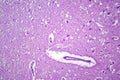 Histopathology of Japanese encephalitis, light micrograph