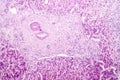 Histopathology of liver abscess Royalty Free Stock Photo