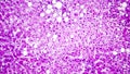 Histopathology of liver steatosis, or fatty liver