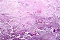 Histopathology of lymph nodal tuberculosis Royalty Free Stock Photo