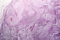 Histopathology of lymph nodal tuberculosis Royalty Free Stock Photo