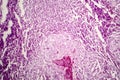 Histopathology of lymph nodal tuberculosis