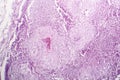 Histopathology of lymph nodal tuberculosis Royalty Free Stock Photo