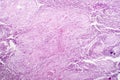 Histopathology of lymph nodal tuberculosis Royalty Free Stock Photo