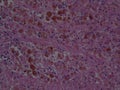 Histopathology of Melanoma granules look like IHC slides