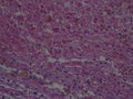 Histopathology of Melanoma Royalty Free Stock Photo