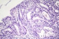 Histopathology of nasal polyps Royalty Free Stock Photo