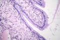 Histopathology of nasal polyps Royalty Free Stock Photo