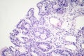 Histopathology of nasal polyps Royalty Free Stock Photo