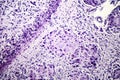 Histopathology of postnecrotic liver cirrhosis Royalty Free Stock Photo