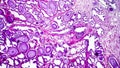 Histopathology of prostate gland hyperplasia