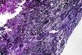 Histopathology of silicosis, light micrograph Royalty Free Stock Photo