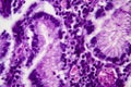 Gastric adenocarcinoma, light micrograph