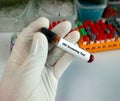 HIV (human immunodeficiency virus) screening test. Technician hold test tube, health and medical concept.