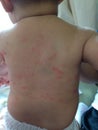 Hives in infant or baby