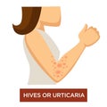 Hives or urticaria disease skin inflammation immune system damage Royalty Free Stock Photo